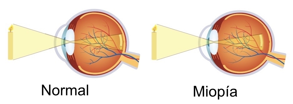 Ojo normal y ojo miope